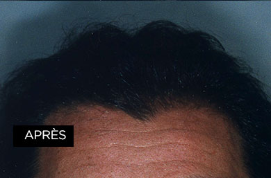 greffe de cheveux, après le traitement