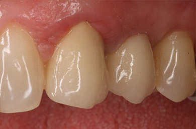 sremplacement dent implant dentaire