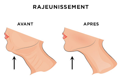 srajeunissement maxillo facial