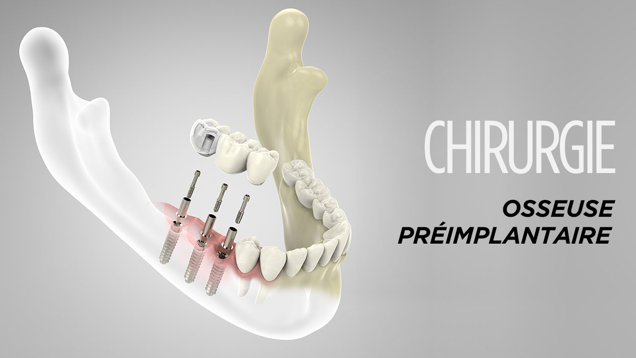 chirurgie préimplantaire