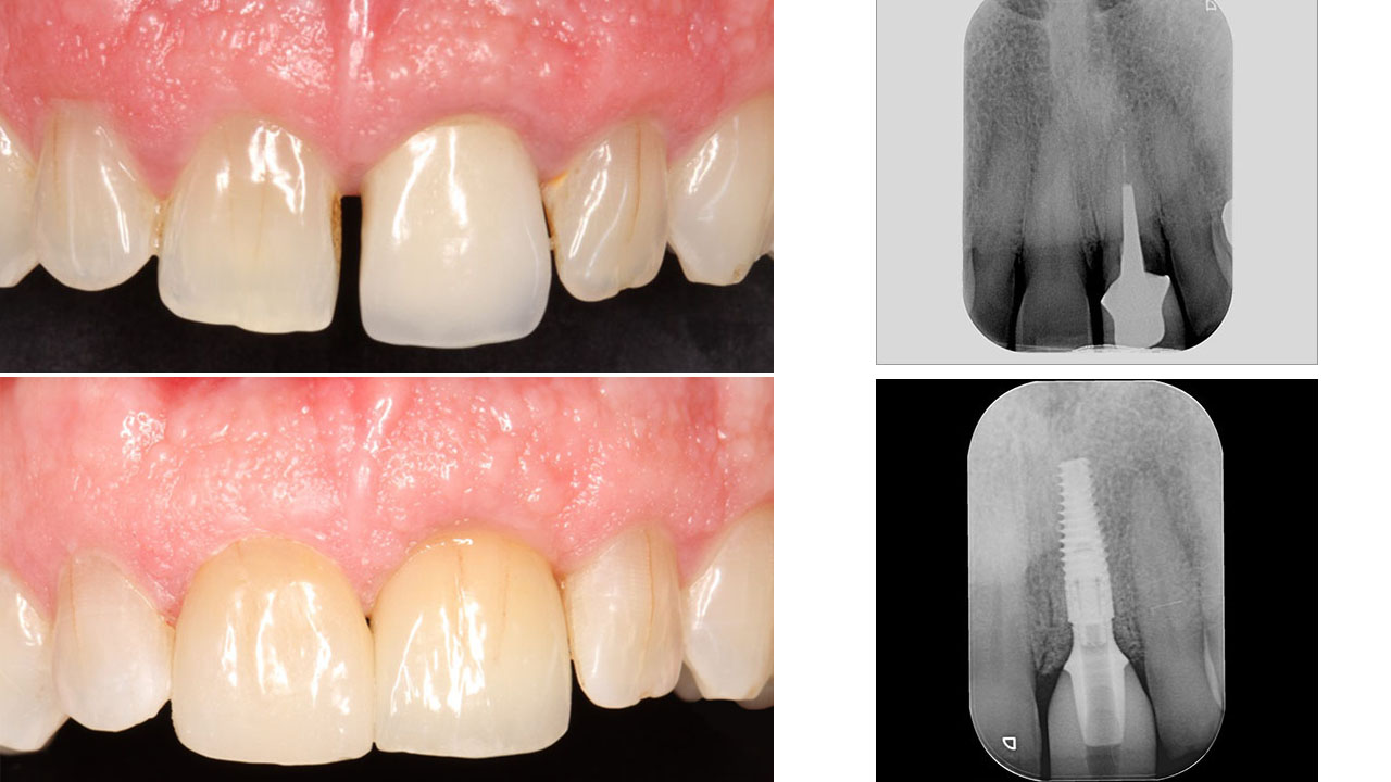 implant dentaire fracture incisive