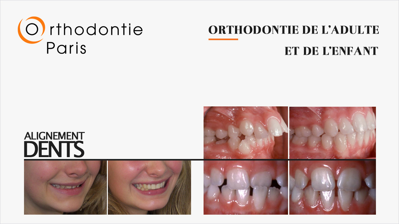 alignement des dents