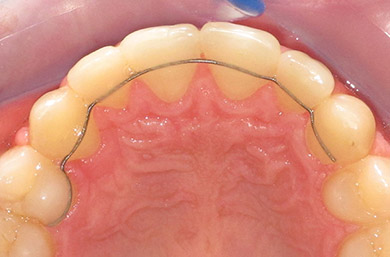 contentions collées orthodontiques