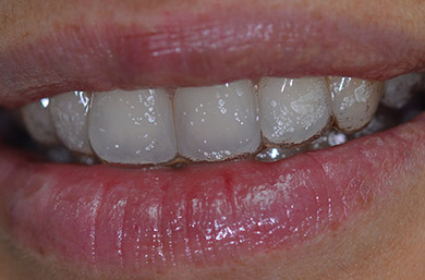 Invisalign orthodontie Paris